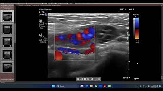 Nice illustrative ultrasound case of inguinal hernia in female Vs Round ligament Varices [upl. by Ameyn706]