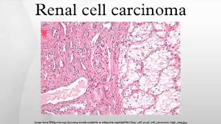 Renal cell carcinoma [upl. by Ettenwahs610]