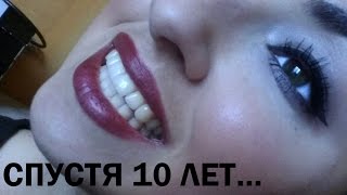 БРЕКЕТЫ МОЯ ПРАВДА СПУСТЯ 10 ЛЕТ [upl. by Navis651]