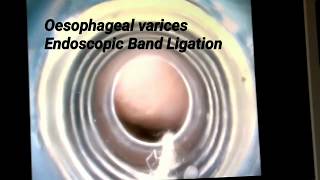 Endoscopic Band Ligation of oesophageal varices [upl. by Heimer]