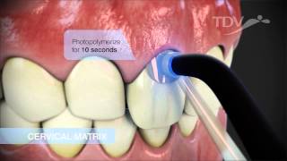 CERVICAL MATRIX TDV  Class V Restorations [upl. by Triny]