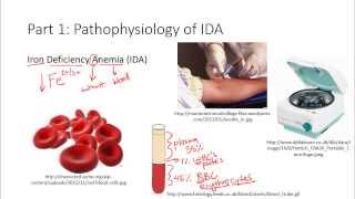 Part 1 of 3 Pathophysiology of Iron Deficiency Anemia Khan Academy NCLEXRN [upl. by Ibmat]