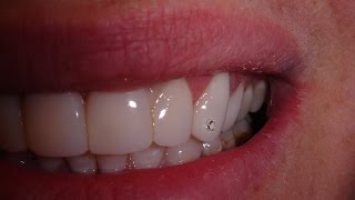 Dental Composite veneers time lapse  spot the real Diamond [upl. by Corrina718]