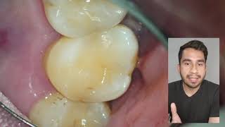 Fractura Radicular Horizontal en un Molar Superior [upl. by Ocirema]