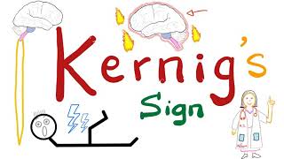 Kernig Sign  Meningitis  Neurology Physical Exam [upl. by Myrlene593]