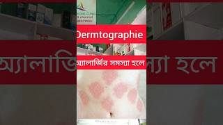 Allergy urticaria Dermtographie Bengali [upl. by Ainslie105]