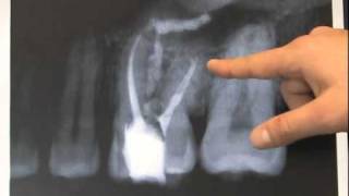 Endodontic Case  Found Calcium Hydroxide [upl. by Leiahtan176]