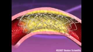 Heartistry Stent Implant Animation [upl. by Biancha662]