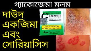 Gacozema Ointment দাউদ একজিমা এবং সোরিয়াসিস চিকিৎসায় নির্দেশিত গ্যাকোজেমা ক্রিম Eczema David [upl. by Leilah]