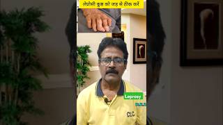 कुष्ठ रोग को जड़ से ठीक करें leprosy leprosytreatment homeopathy [upl. by Nallaf]