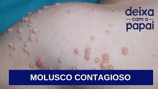 MOLUSCO CONTAGIOSO O QUE É COMO TRATAR QUAIS CUIDADOS DEVEMOS TER DEIXA COM O PAPAI [upl. by Hughmanick]