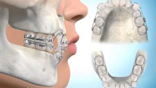 Four bicuspid Extraction all 1st no proclination [upl. by Llertnor]