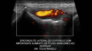 ULTRASSOM DO COTOVELO  EPICONDILITE LATERAL COM FLUXO AO DOPPLER [upl. by Janus217]