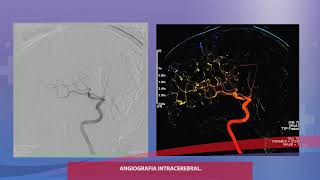 Angioplastia carotidea separado por más de 15 días [upl. by Llovera]