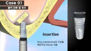 SinusT sinus lift technique for dental implants using DIOs specialist burrs and osteotome kit [upl. by Avie508]