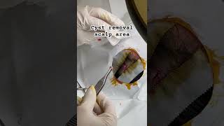 Cyst removal [upl. by Kara]