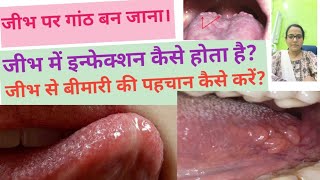 जीभ पर गांठ बन जानाHow to cure tongue related problemNormal structure of tongue tongue bump normal [upl. by Oznohpla451]