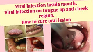 Viral infection inside mouthViral infection on tongue lip and cheek regionHow to cure oral lesion [upl. by Scully]