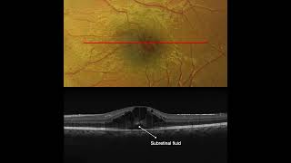 Cystoid Macular Edema in Pars Planitis OCT Interpretation [upl. by Riatsila426]