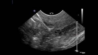 endometrium post lscs2aavi [upl. by Pitt346]