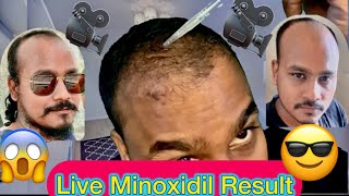 Live MINOXIDIL USE  MINTOP 5 [upl. by Liew]