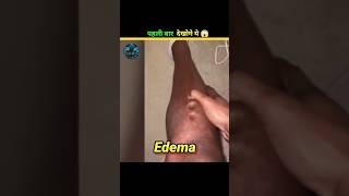 Edema Ko kese theek Karen edema fects shorts [upl. by Aicinoid]