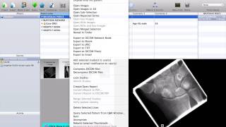 How to anonymise cases in OsiriX for teaching purposes [upl. by Sherburn743]