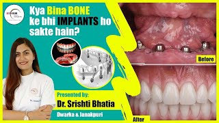 Kya Bina BONE ke Teeth IMPLANTS ho sakte hain Dr Srishti Bhatia teethimplants implants [upl. by Bren250]