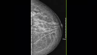 CASE 192 left breast intramammary lymphadenopathy [upl. by Sihon]