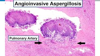 Lung Histopathologic Review Preparation for Boards Exams AND for Daily Practice [upl. by Karilynn292]