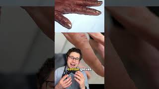 What is dyshidrotic eczema eczema rash doctor [upl. by Mini]