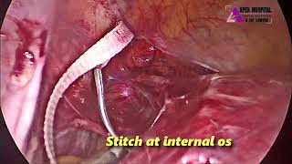 Laparoscopic Abdominal Cerclage by Dr R K Mehta  Apex Hospital Sirsa [upl. by Ravens984]