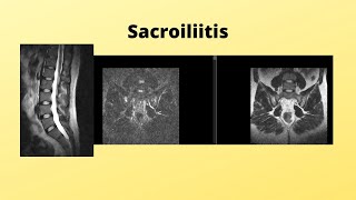 Sacroiliitis [upl. by Fredelia]