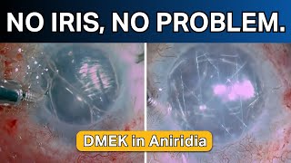 No iris no problem DMEK in aniridia [upl. by Og]