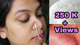 HOW TO REMOVE BLACKHEADS INSTANTLY amp PERMANENTLY  PAINLESS HOME REMEDY [upl. by Hayimas]