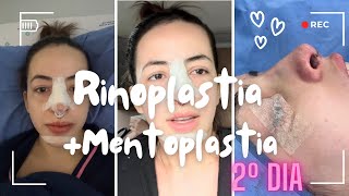 Rinoplastia  mentoplastia  Segundo dia [upl. by Htebezile]