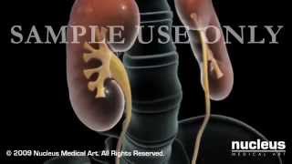 Bladder cancer  all about Bladder Cancer PainTreatment  Disease 2016 [upl. by Arria]