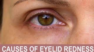 Causes of Eyelid Redness [upl. by Lolly]