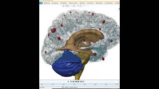 Cysticercosis 3D reconstruction of a patient [upl. by Ataliah]