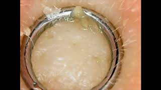 Comedone Extractions on Nose An Educational Video [upl. by Stutsman]