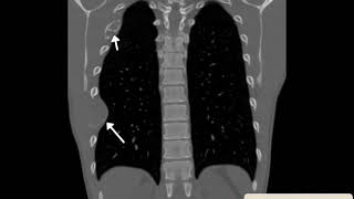 Fibrous Dysplasia [upl. by Iatnohs839]