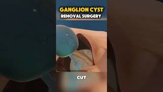 Ganglion Cyst Removal Surgery medical medical3danimation [upl. by Hallette271]