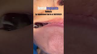 Dental Implant Kolkata shorts shortsvideo ytshorts viral shortfeed shortsvideo look kolkata [upl. by Vitia]