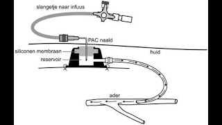 Afsluiten van de poortkatheter [upl. by Aivil519]