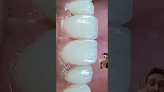 FECHAMENTO DE ESPAÇOS  DIASTEMAS COM RESINAS dentista facetadental odontologia [upl. by Natsud]