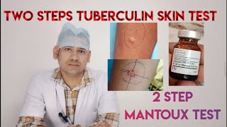 two step TUBERCULIN skin testtwo steps mantoux test mantoux test PPD SENSTIVITY TEST [upl. by Llamaj]