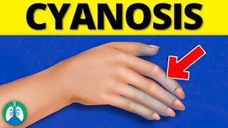 What is Cyanosis EXPLAINED [upl. by Edward]