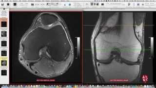 Systematic Interpretation of Knee MRI How I do it [upl. by Balbur]