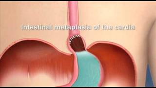 Barretts Esophagus Intestinal Metaplasia of the CardiaMayo Clinic [upl. by Gnuhc860]