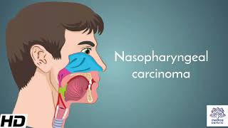 Nasopharyngeal carcinoma Causes Signs and Symptoms Diagnosis and Treatment [upl. by Topping]